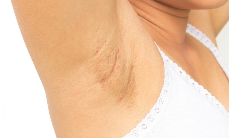 como aclarar las axilas oscuras y manchadas de forma rápida y fácil